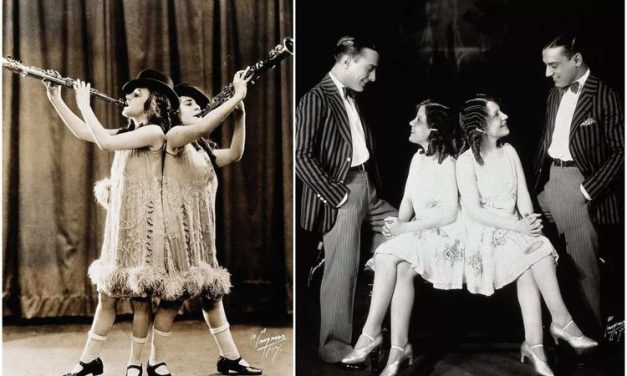 Kisah Tragis Kembar Siam Daisy Dan Violet Hilton Lepas Dari Ibu