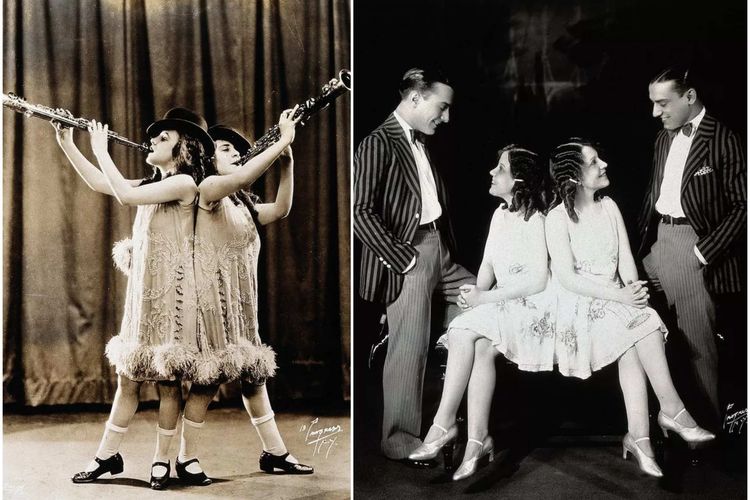 Kisah Tragis Kembar Siam Daisy Dan Violet Hilton Lepas Dari Ibu